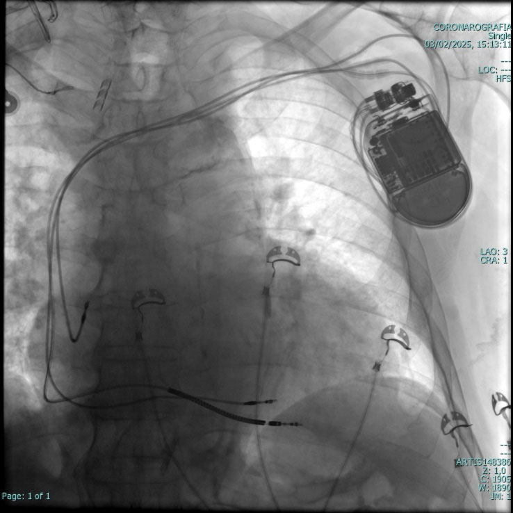 Pace maker leadless cardiologia Vallo della Lucania