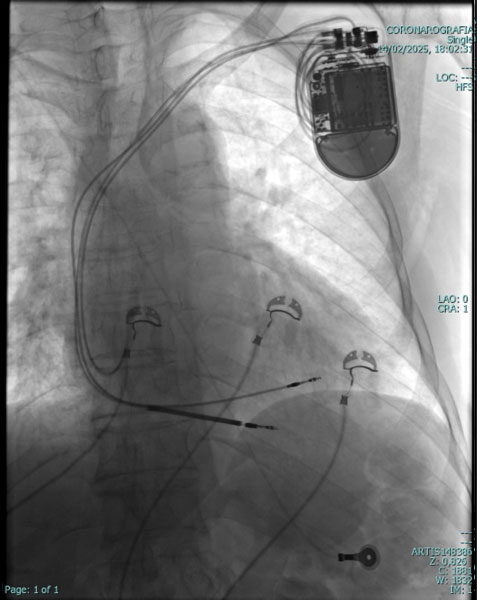 Pace maker leadless cardiologia Vallo della Lucania