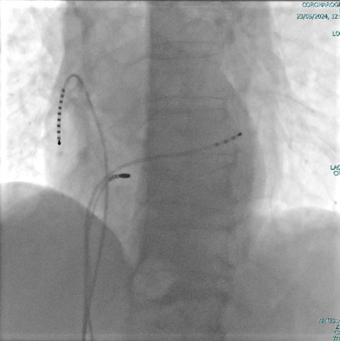 Elettrofisiologia cardiologia Vallo della Lucania