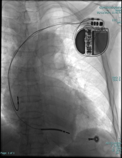 Pace maker leadless cardiologia Vallo della Lucania