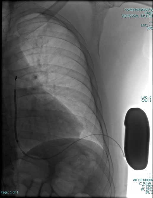 Pace maker leadless cardiologia Vallo della Lucania