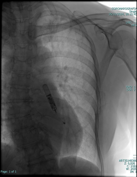 Loop recorder cardiologia Vallo della Lucania
