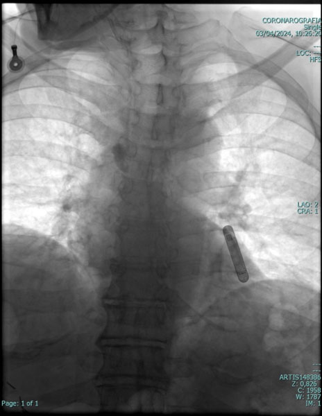 Loop recorder leadless cardiologia Vallo della Lucania