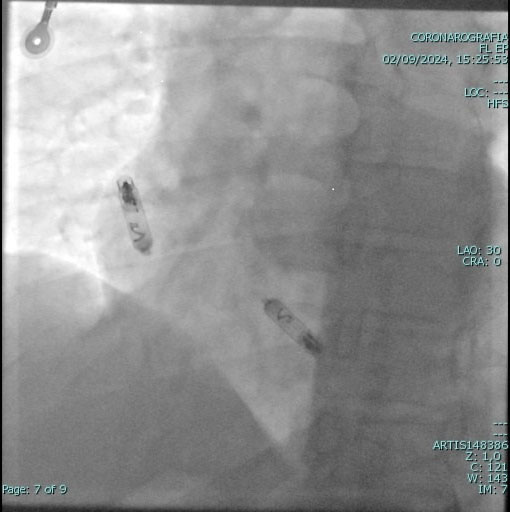 Pace maker leadless cardiologia Vallo della Lucania