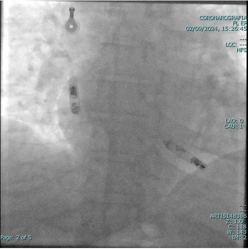 Pace maker leadless cardiologia Vallo della Lucania