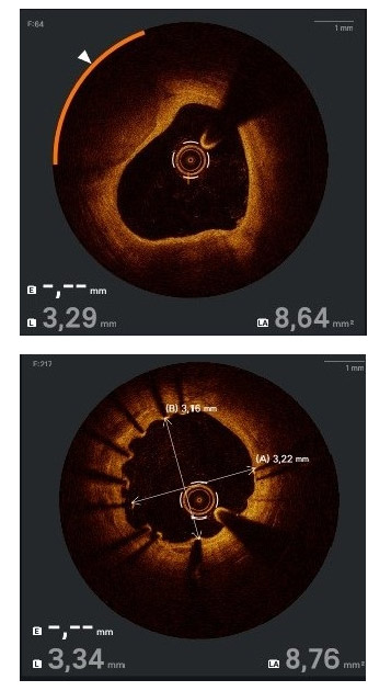 Optimal Coherence Tomography ospedale vallo della lucania